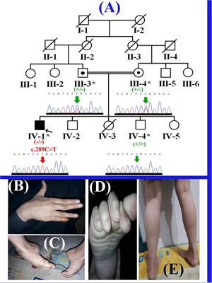 SGCD Homozygous Nonsense Mutation (p.Arg97∗) Causing Limb-Girdle Muscular Dystrophy Type 2F (LGMD2F) in a Consanguineous Family, a Case Report